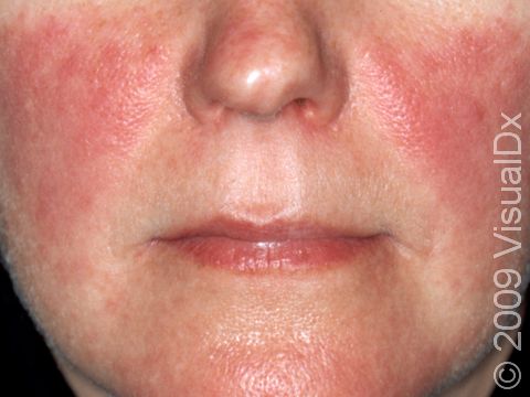 The dull red patches of systemic lupus are prominent in sun-exposed areas. When these patches are seen on the cheeks, one can imagine why the term 